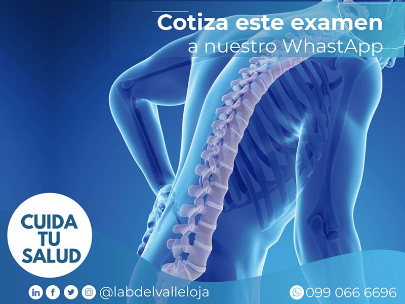 analisis clinico Osteoporosis